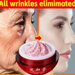 "Dragon Blood Cream – Wrinkle Removal