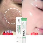 Salicylic Acid Cream - Reduces blackheads