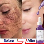 Dark Spot Remover Gummies