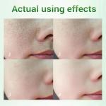 Salicylic Acid Cream - Reduces blackheads
