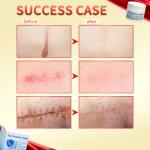 Fast Scar Removal Cream