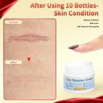 Fast Scar Removal Cream